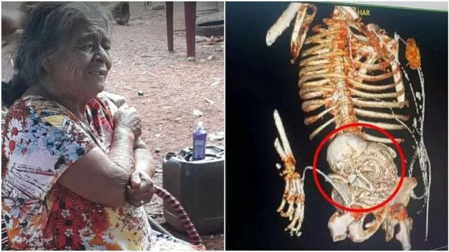 Uma mulher vai ao médico por causa de uma pedra, eles encontram um bebê calcificado de 30 anos e ela morre durante a operação