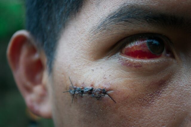 Um manifestante em Palo Quemado mostra seu ferimento.
