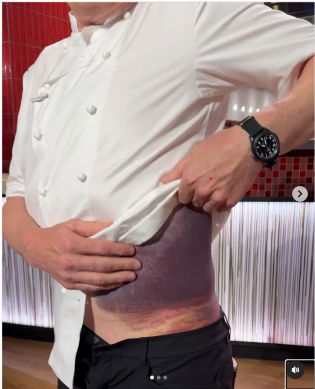 Foto de Gordon Ramsay com um hematoma terrível.