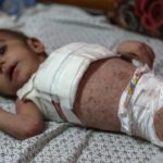 Doenças de pele perigosas que se espalham entre crianças desnutridas em Gaza