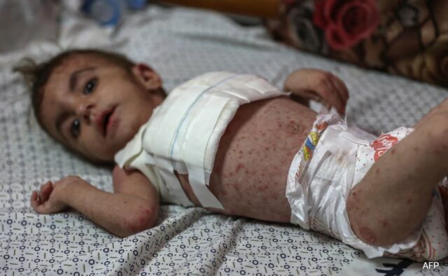 Doenças de pele perigosas que se espalham entre crianças desnutridas em Gaza